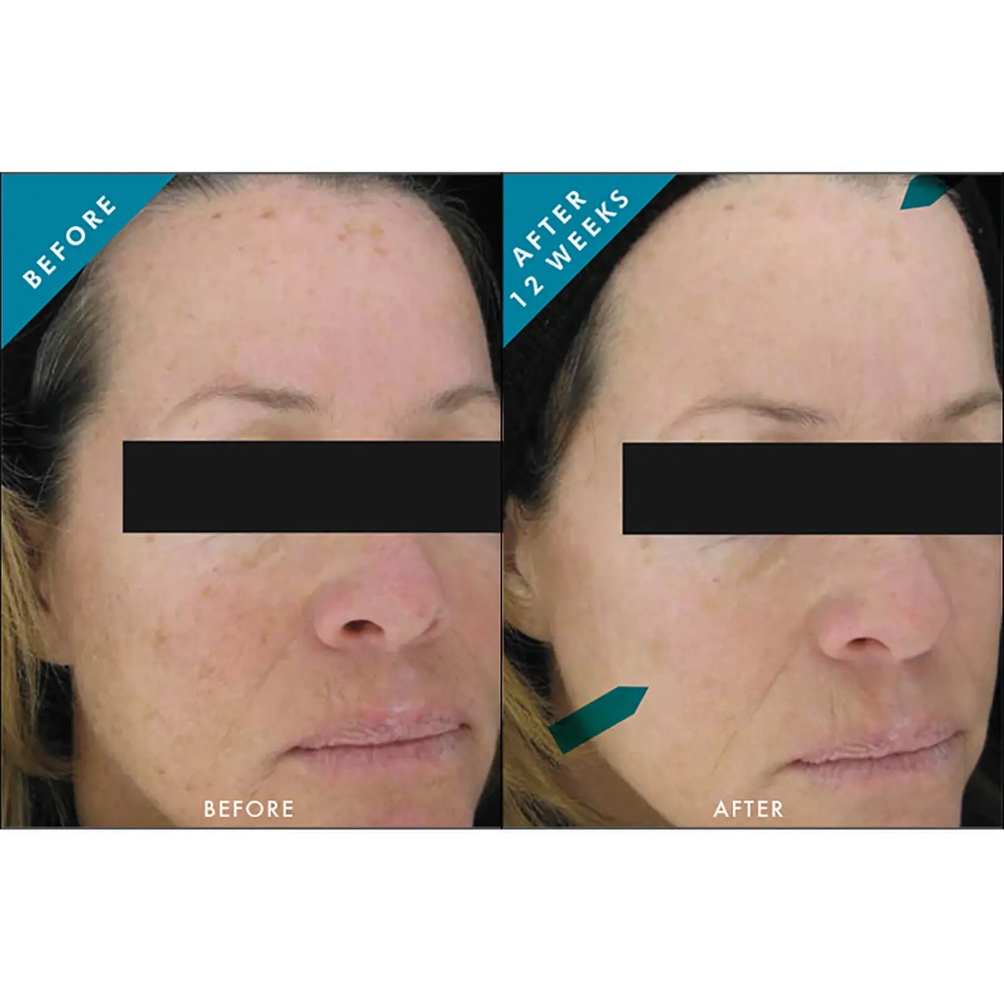SkinCeuticals Phloretin CF Gel (1 fl. oz.)